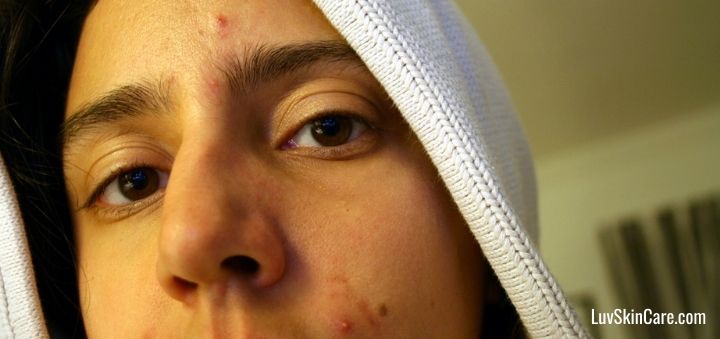 What Is Acne?