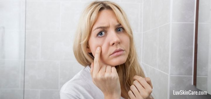 What Is the Difference Between Acne and Pimples